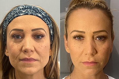 Sirius Med Spa Botox