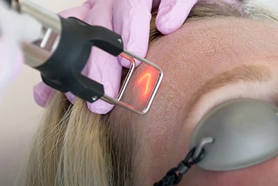 Sirius Med Spa CoolPeel CO2 laser hair removal