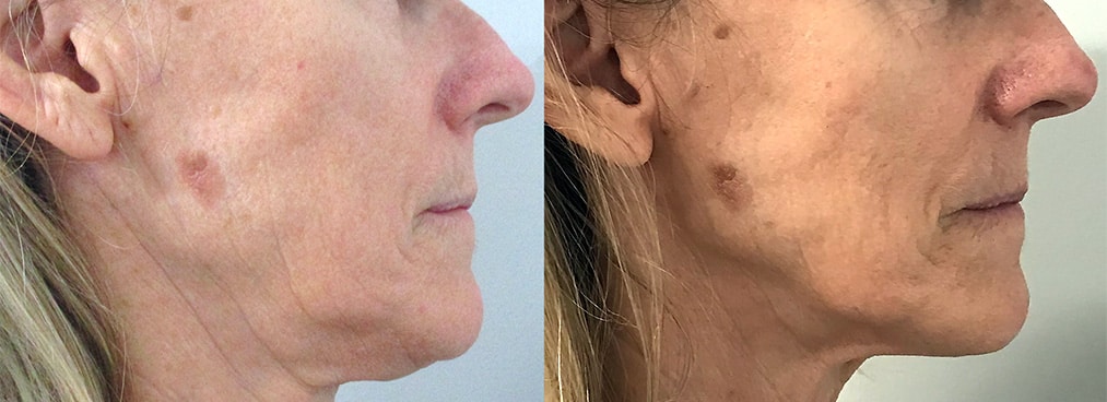 Sirius Med Spa Morpheus8 Microneedling